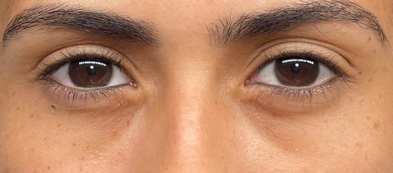 Antes: LINER INFERIOR | ANTES Y DESPUÉS