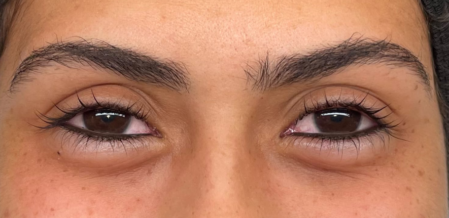 Después: LINER INFERIOR | ANTES Y DESPUÉS