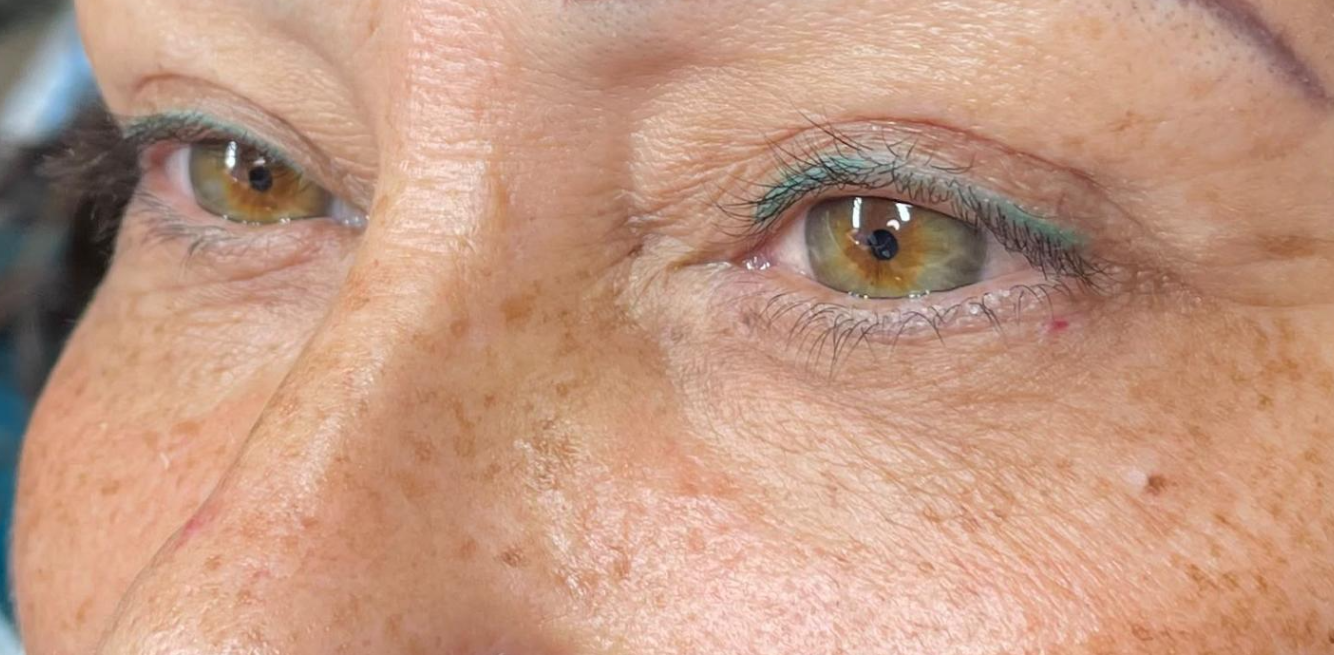 Antes: LINER PERMANENTE SUPERIOR | ANTES Y DESPUÉS