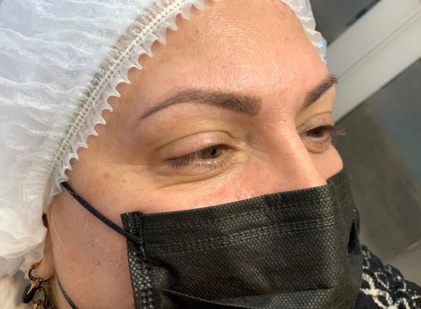 Antes: LINER PERMANENTE SUPERIOR | ANTES Y DESPUÉS