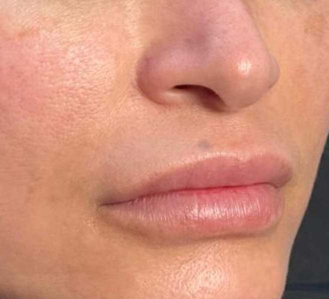 Antes: MICROPIGMENTACIÓN DE LABIOS | ANTES Y DESPUÉS