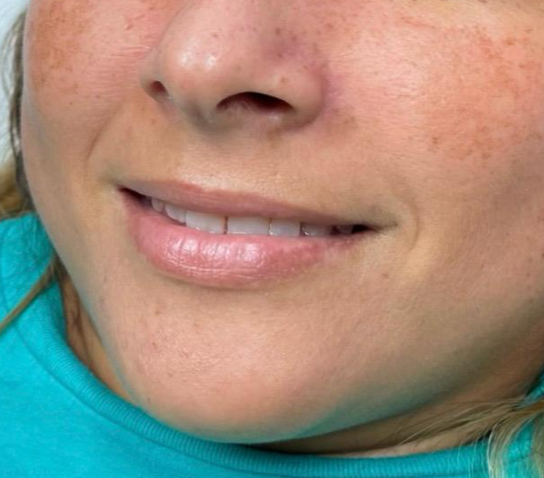 Antes: MICROPIGMENTACIÓN DE LABIOS | ANTES Y DESPUÉS